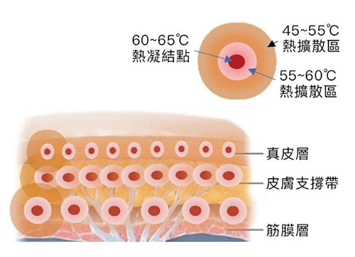 皇后音波熱凝結點與熱擴散區層次解剖：作用於真皮層與筋膜層-致然雅暮醫美診所